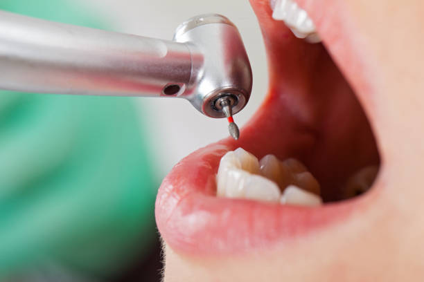 Best Broken or Chipped Tooth Repair in University Of Pittsburgh Johnstown, PA